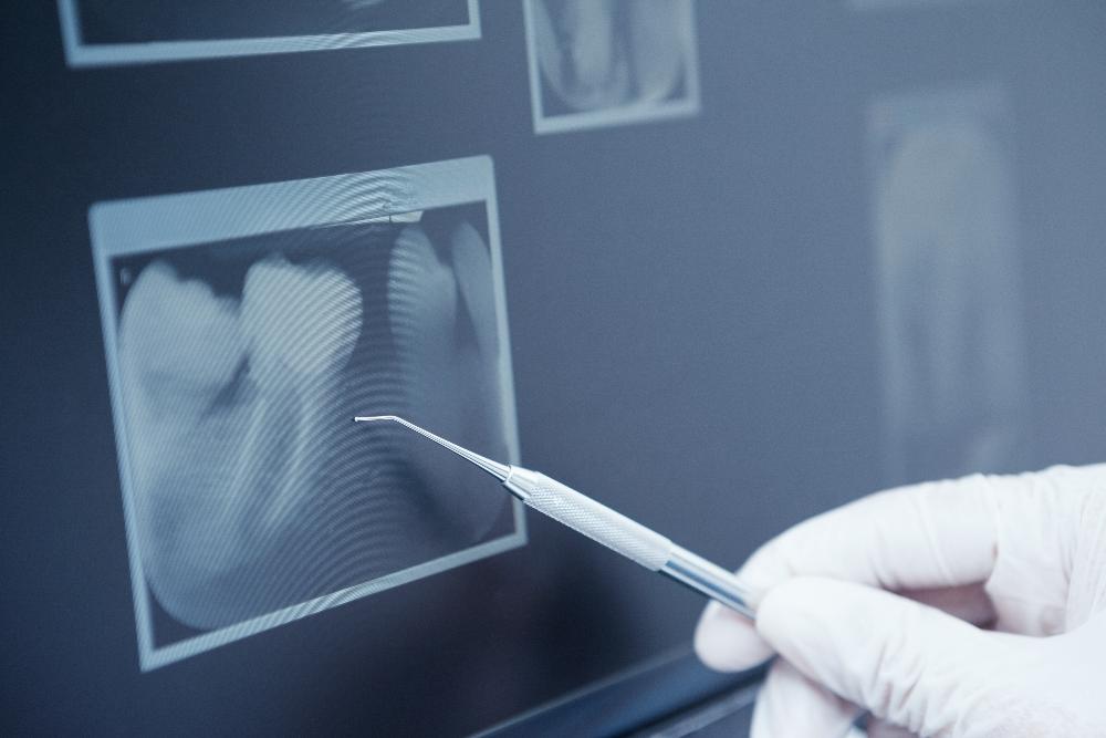 close up of x-ray | emergency dentist huntsville al