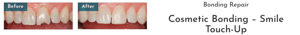 Close up before and after of chipped front tooth, huntsville al
