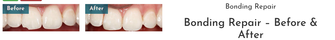 Before and after of chipped tooth, huntsville al