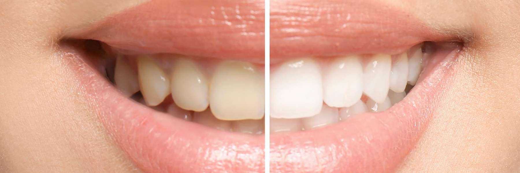 Before and after teeth whitening, huntsville al