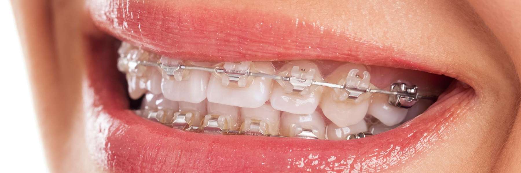 A woman with braces smiling | Huntsville dentist