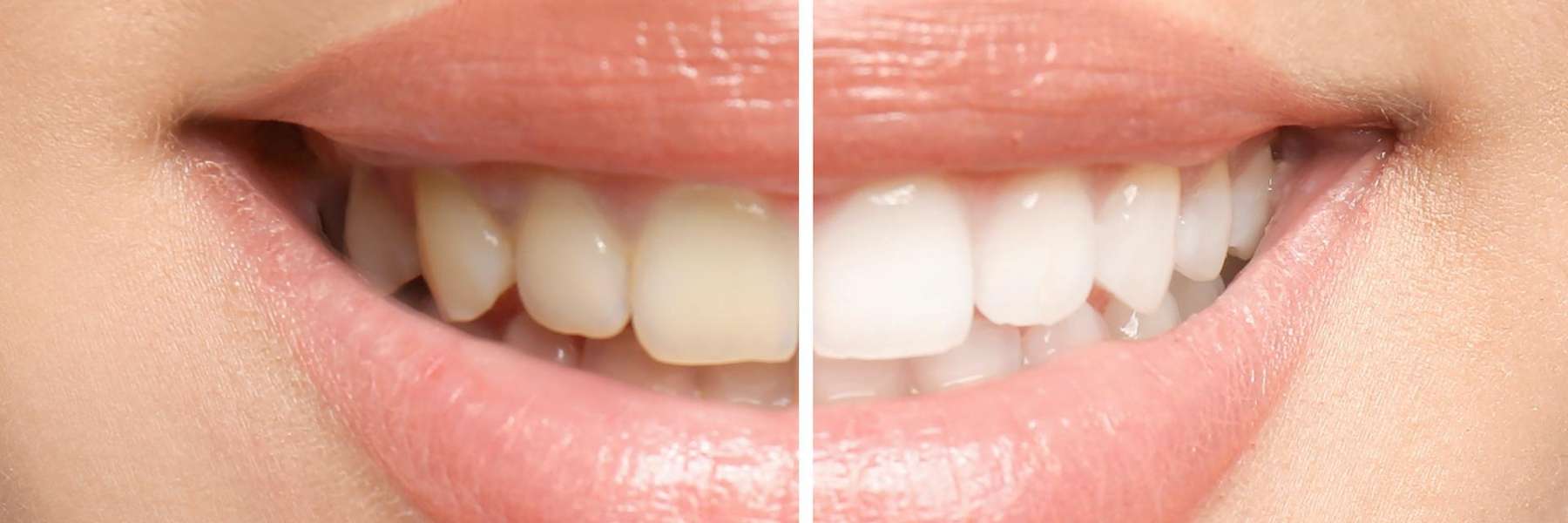 before and after teeth whitening | dentist hunstville al