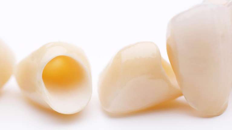 Photos of dental crowns in Huntsville, AL