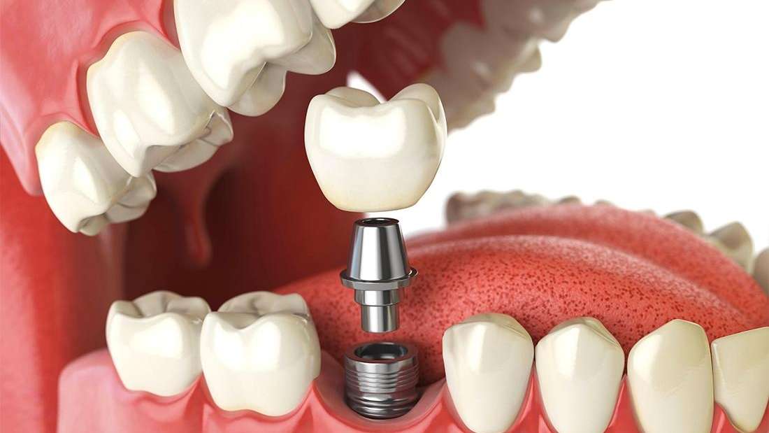 The Benefits of Dental Implants Dental Implants Huntsville AL