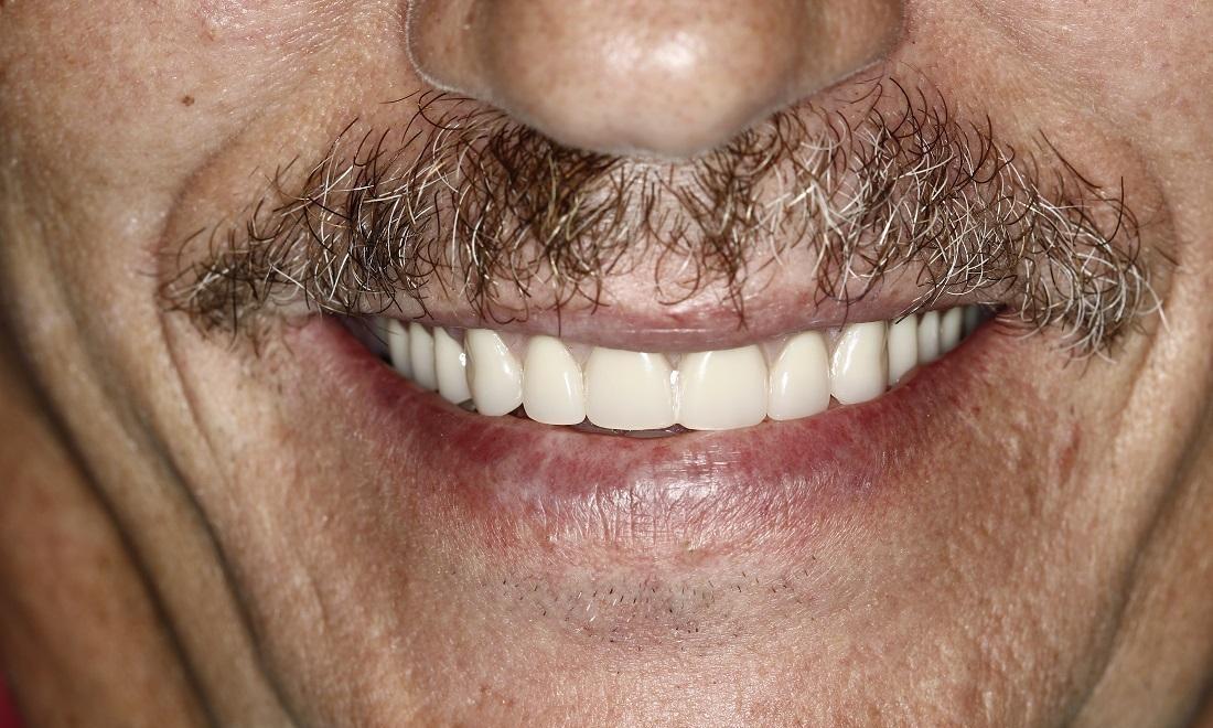Dental Implants Results | Huntsville AL Dentist