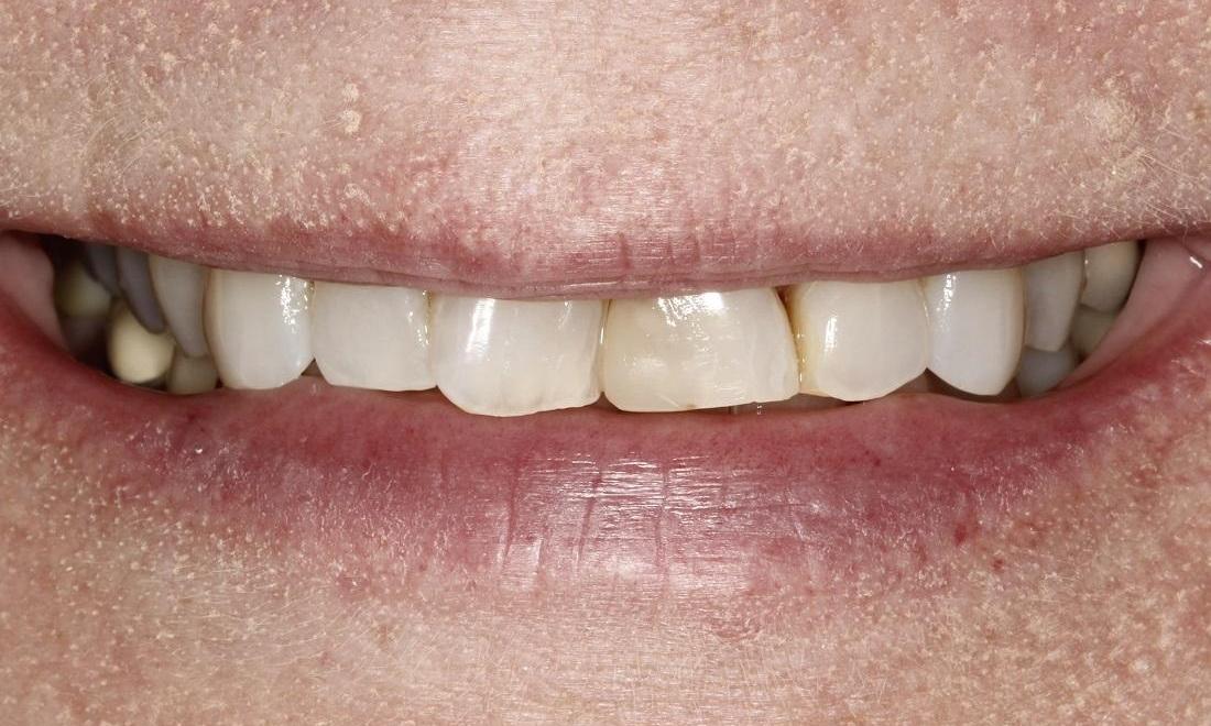 Dental Crowns Before | Huntsville AL Dentist