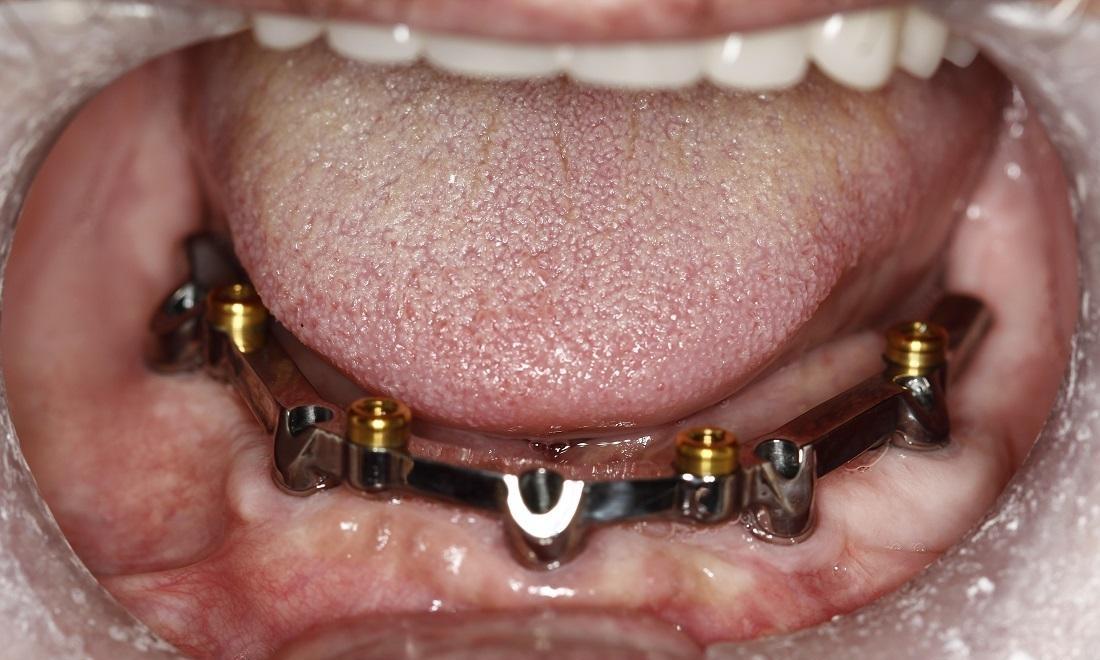 Dental Implants Before Photo | Implant sin H