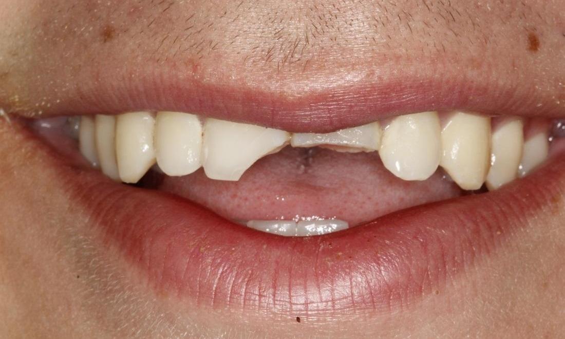 Patient Before Dental Crowns | Huntsville AL