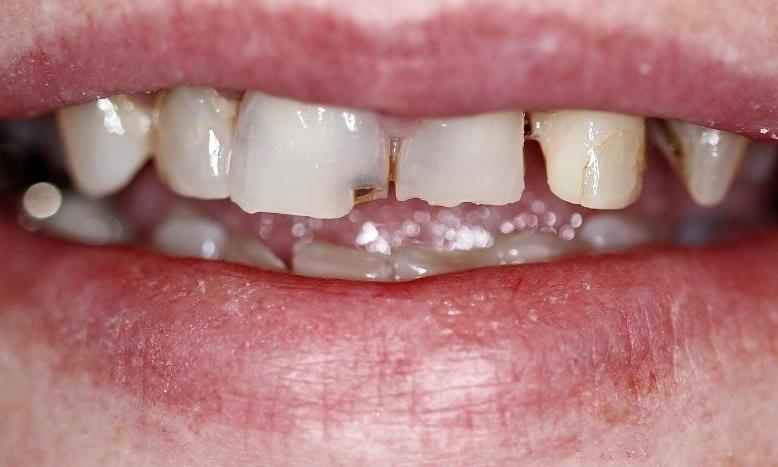 Dental Crowns after photo | Huntsville al