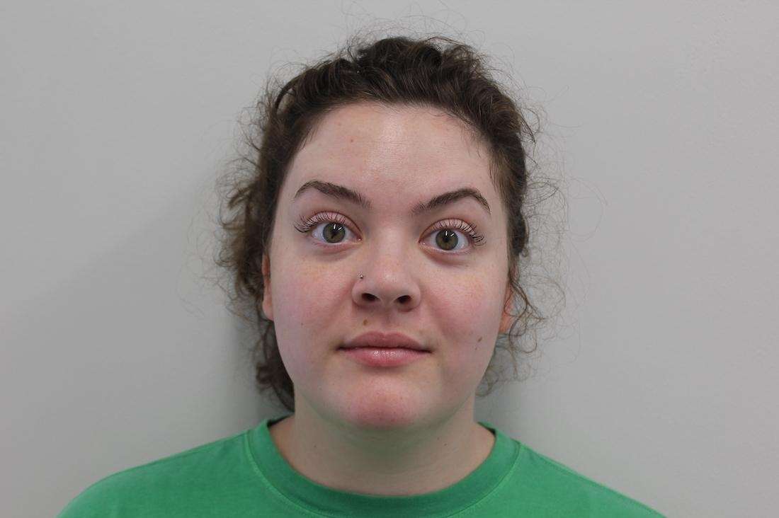 Woman after botox, huntsville al
