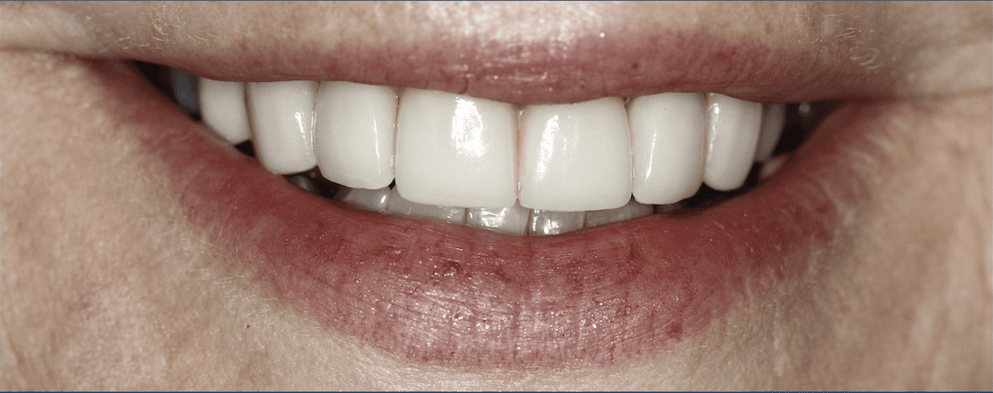 Close up of womans mouth after ceramic crowns, huntsville al