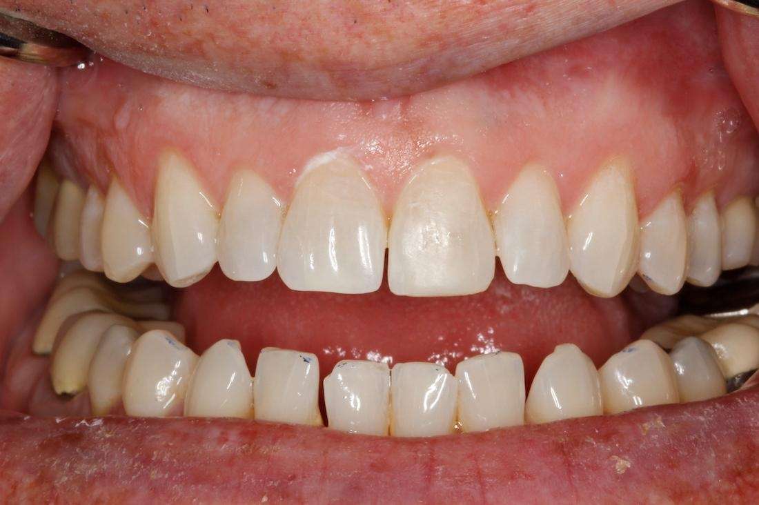 Close up of mouth after composite bonding repair for chipped tooth, huntsville al