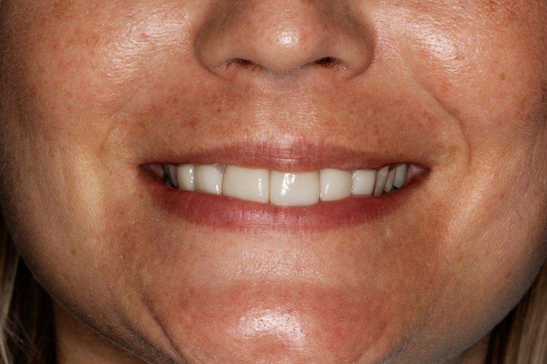 White womens mouth after porcelain crowns, huntsville al