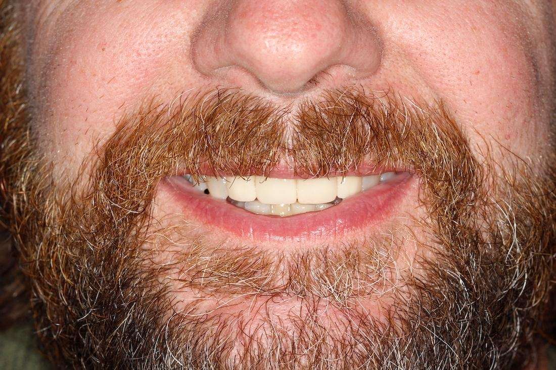 Close up of mans mouth after replacing missing front tooth with an implant, huntsville al