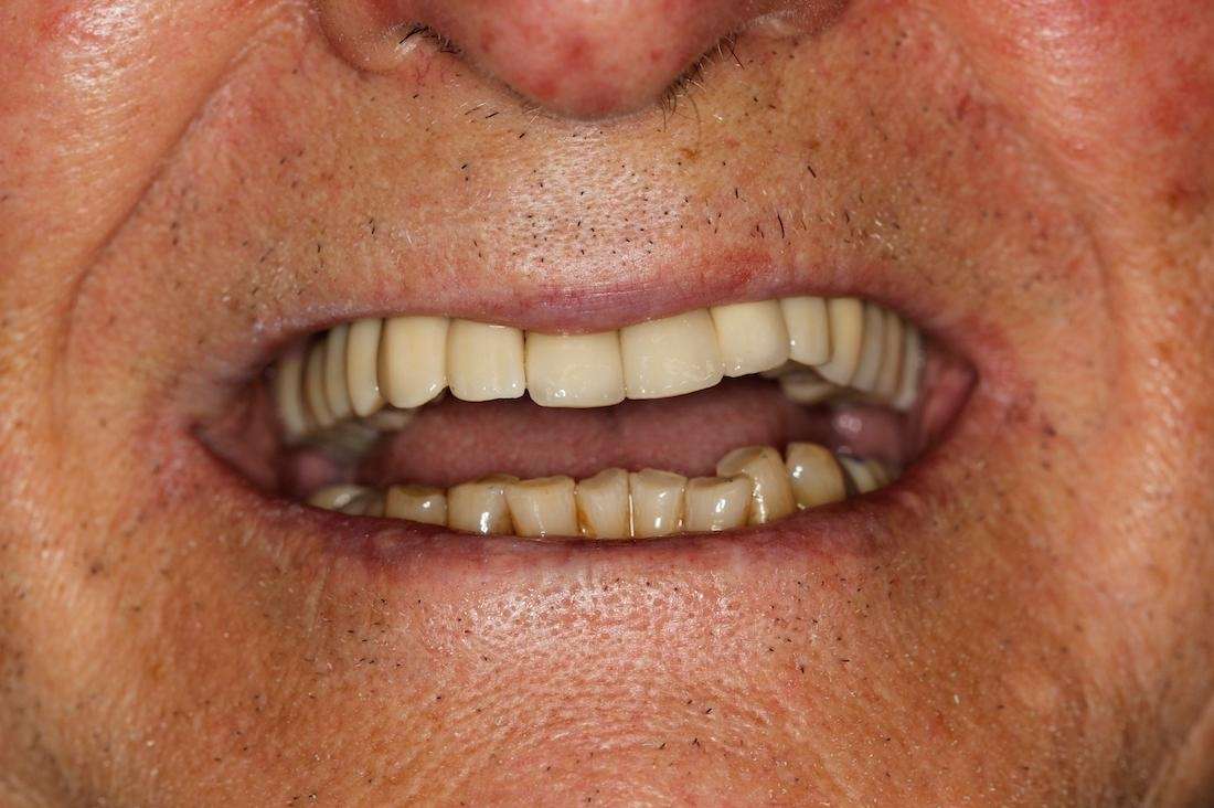 Close up of mans mouth after dental implants, huntsville al