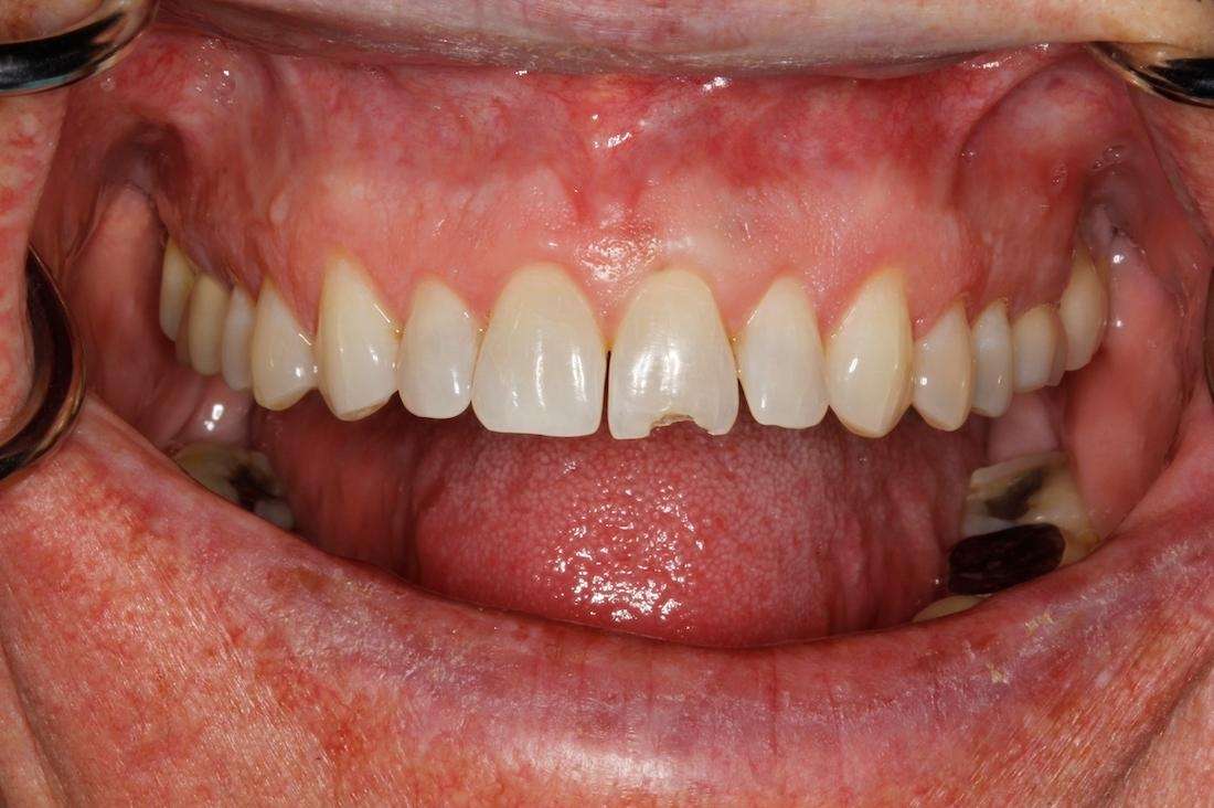Close up of mouth before composite bonding repair for chipped tooth, huntsville al