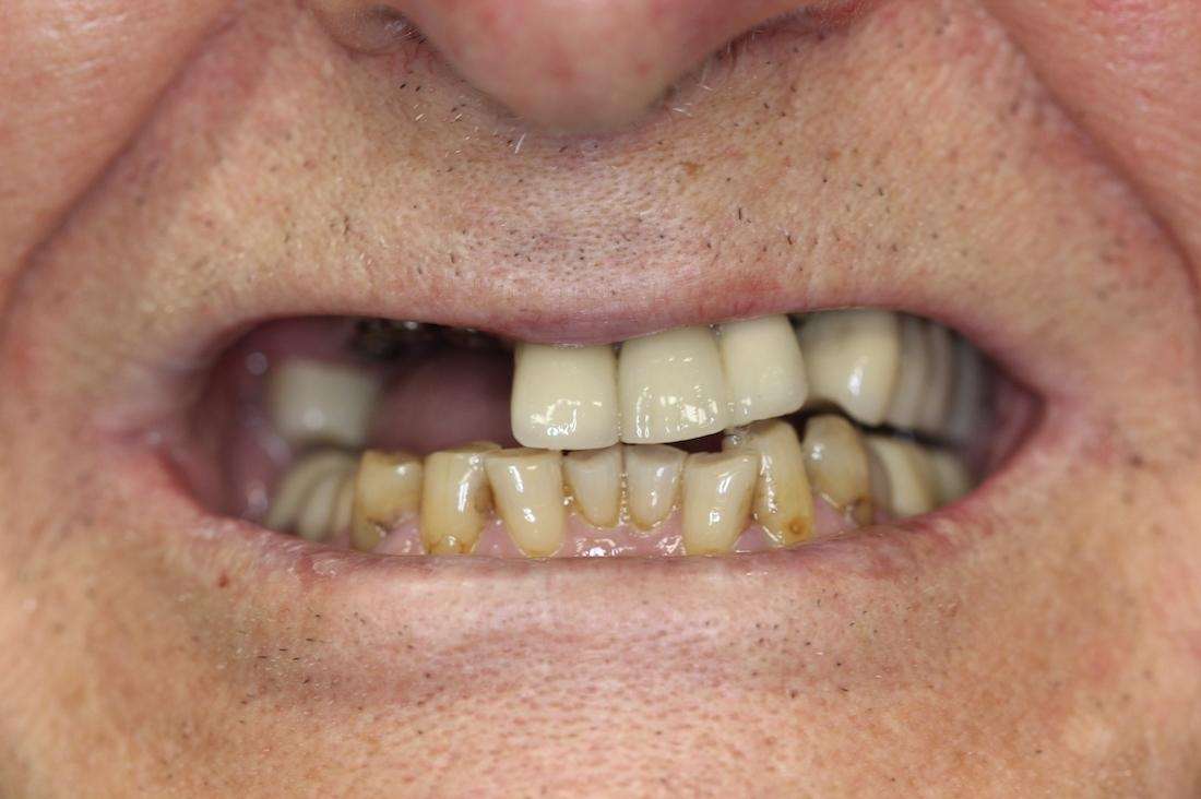 Close up of mans mouth before dental implants, huntsville al