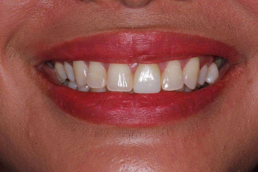 Womens mouth before veneers, huntsville al