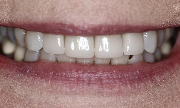 Crowns-After-Image