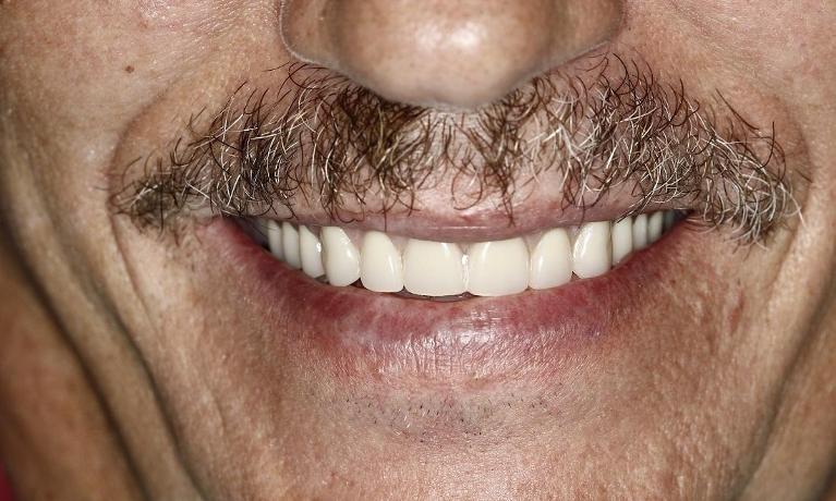 Implant-with-Bar-Denture-After-Image