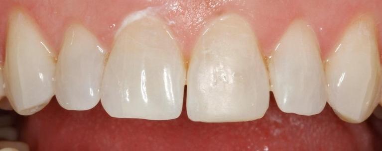 Patient after dental bonding | Huntsville AL