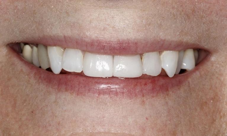Veneers after photos | Huntsville Dentist