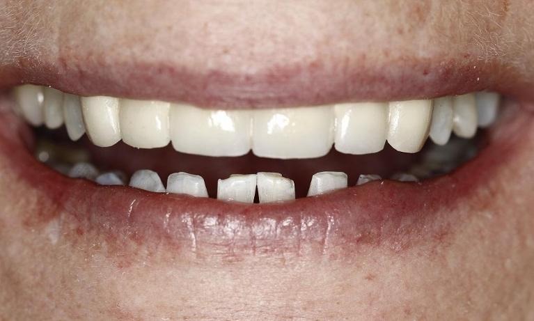 Patient after dental crowns | Huntsville AL Dentist