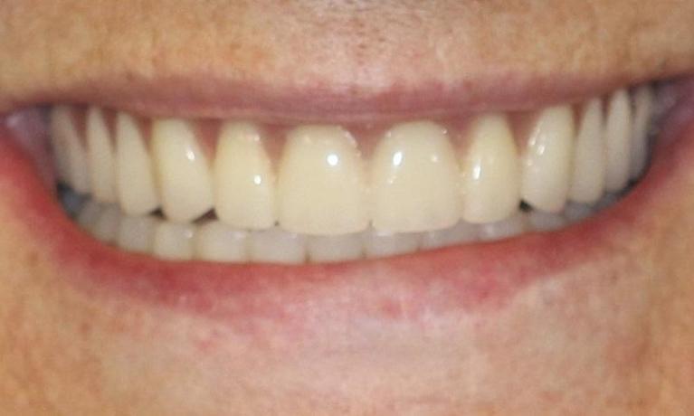 Patient with Dental Implants | Huntsville AL Dentist