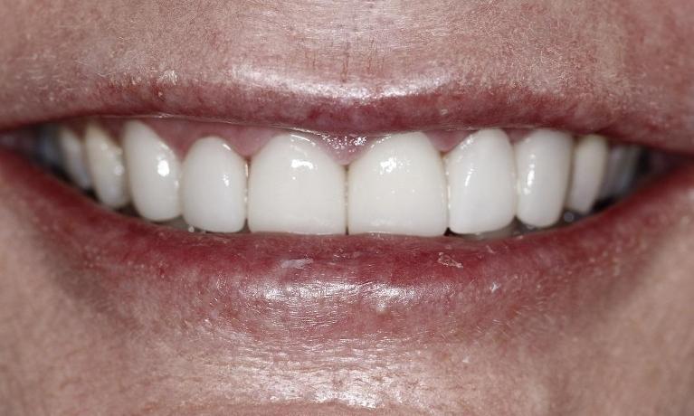 Veneers after photo | Huntsville AL Dentist