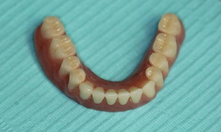 Implant Overdenture final | Huntsville AL Dentist