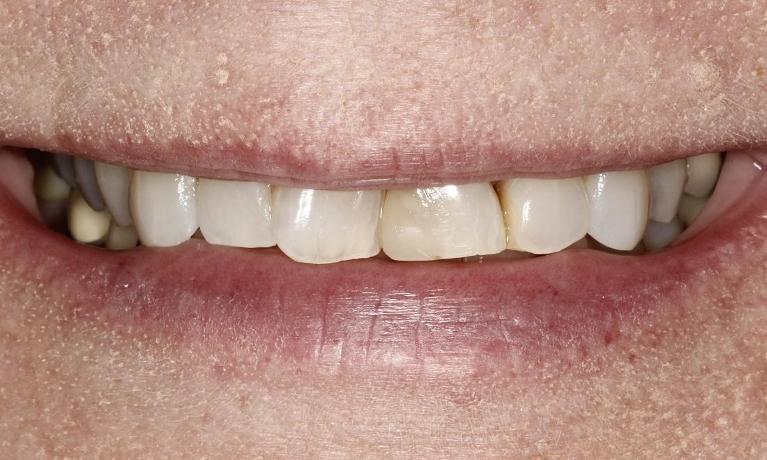Crowns-Before-Image