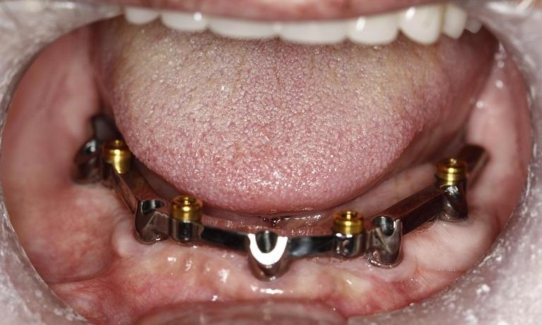Implant-with-Bar-Denture-Before-Image