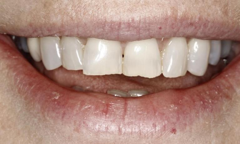 Crowns-Before-Image