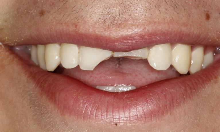 Crowns-Before-Image