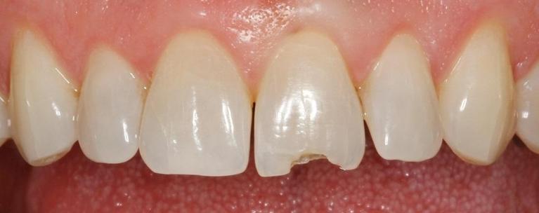 Patient Needing Dental Bonding | Huntsville AL