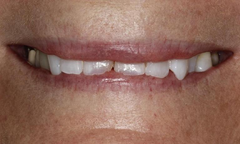 Patient before Veneers | Huntsville AL Dentist