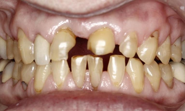 Patient needing dental crowns | Huntsville AL Dentist