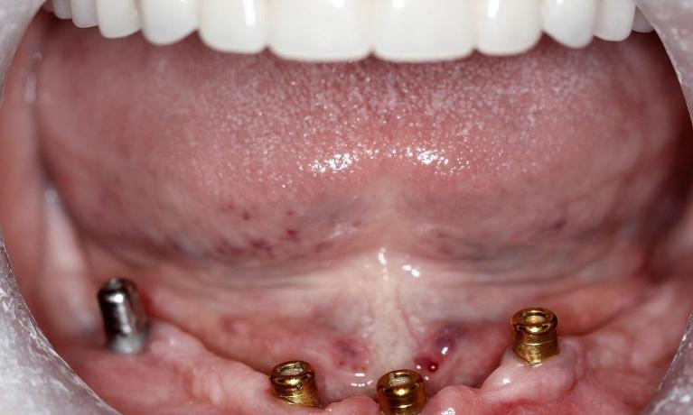 Patient Before Implants | Huntsville AL Dentist