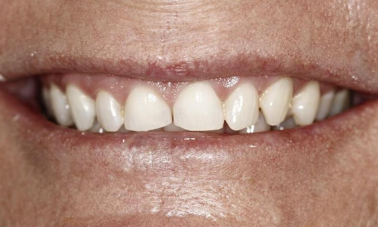 Porcelain veneers after photo | Huntsville AL Dentist