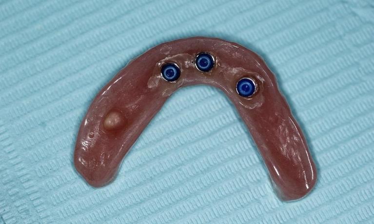 Implant overdenture | Huntsville AL