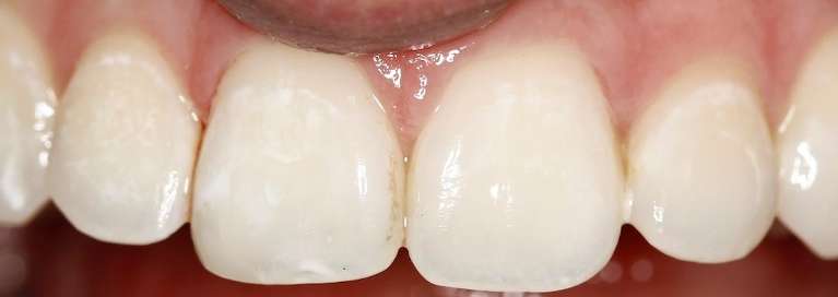 Close up view of teeth after bonding repair, huntsville al