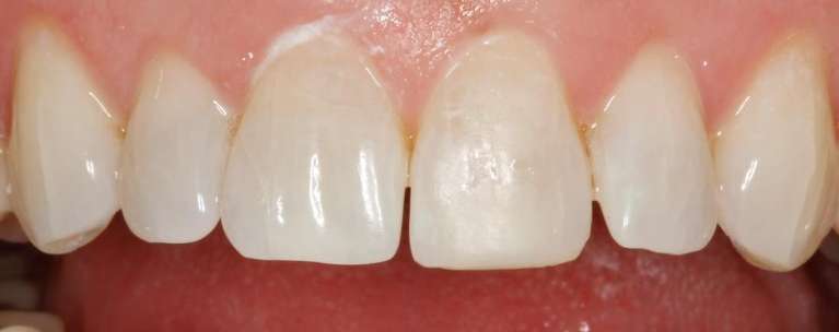 Front teeth after bonding repair, huntsville al