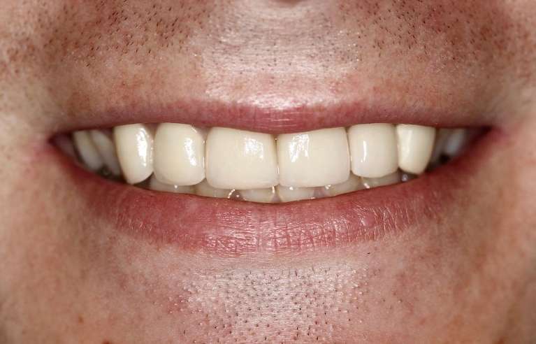 Close up of mans mouth with stubble after ceramic crowns, huntsville al