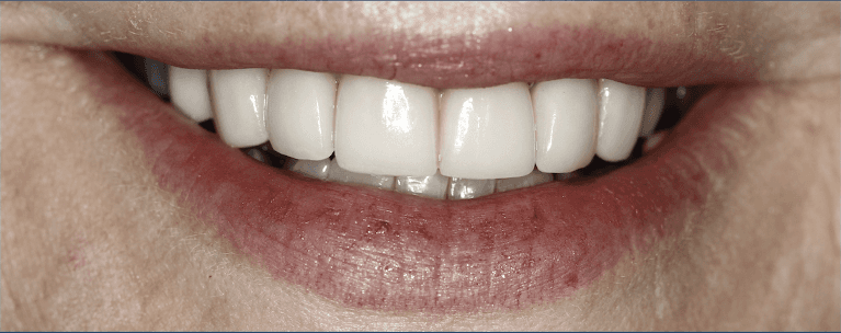 Close up of womans mouth after ceramic crowns, huntsville al