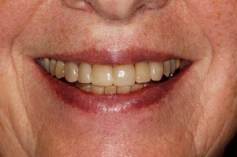 Close up of older womans mouth after ceramic crowns, huntsville al