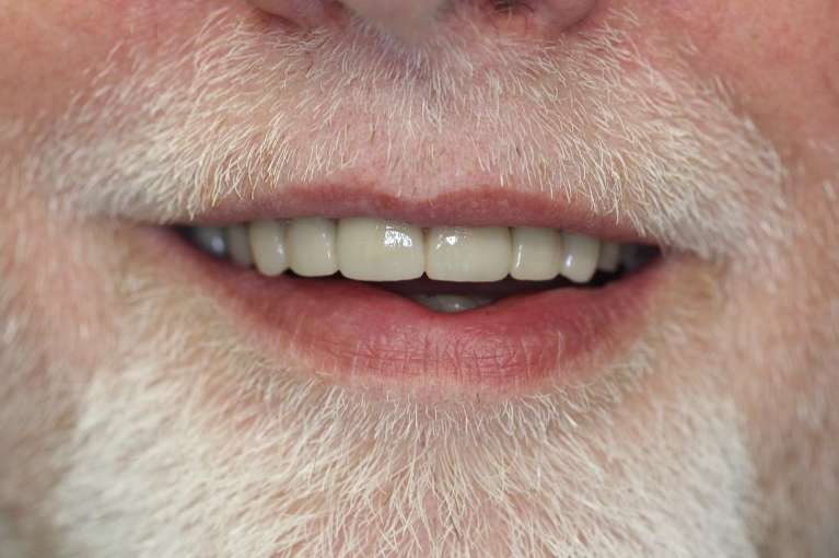 Older man with goatee after ceramic crowns, huntsville al