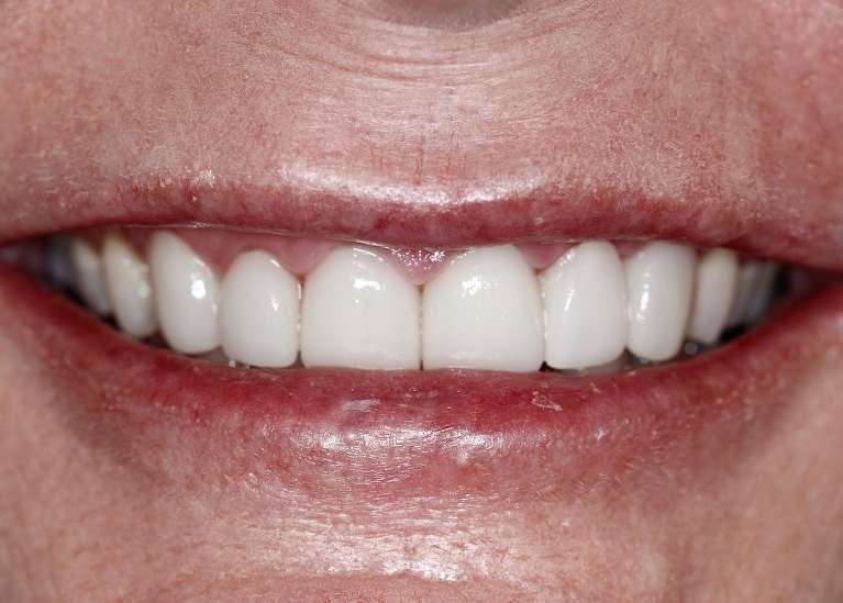Close up of mouth after ceramic veneers, huntsville al