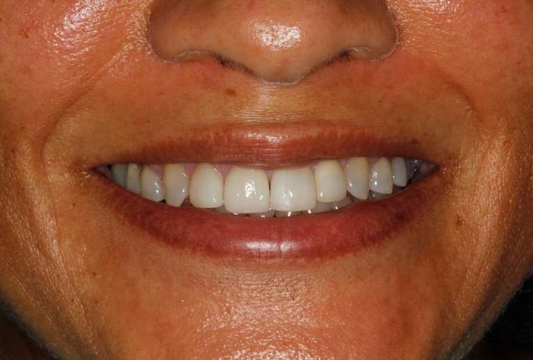 Mouth after ceramic crowns, huntsville al