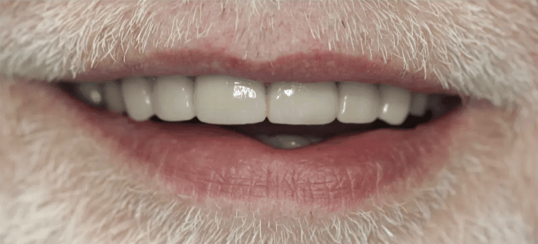 Mans mouth after closing spacing via ceramic crowns, hutnsville al