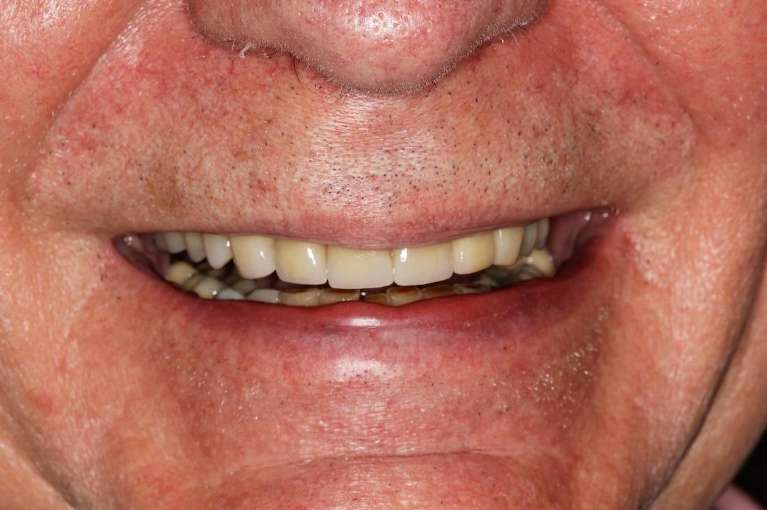 Mans mouth after crowns, huntsville al